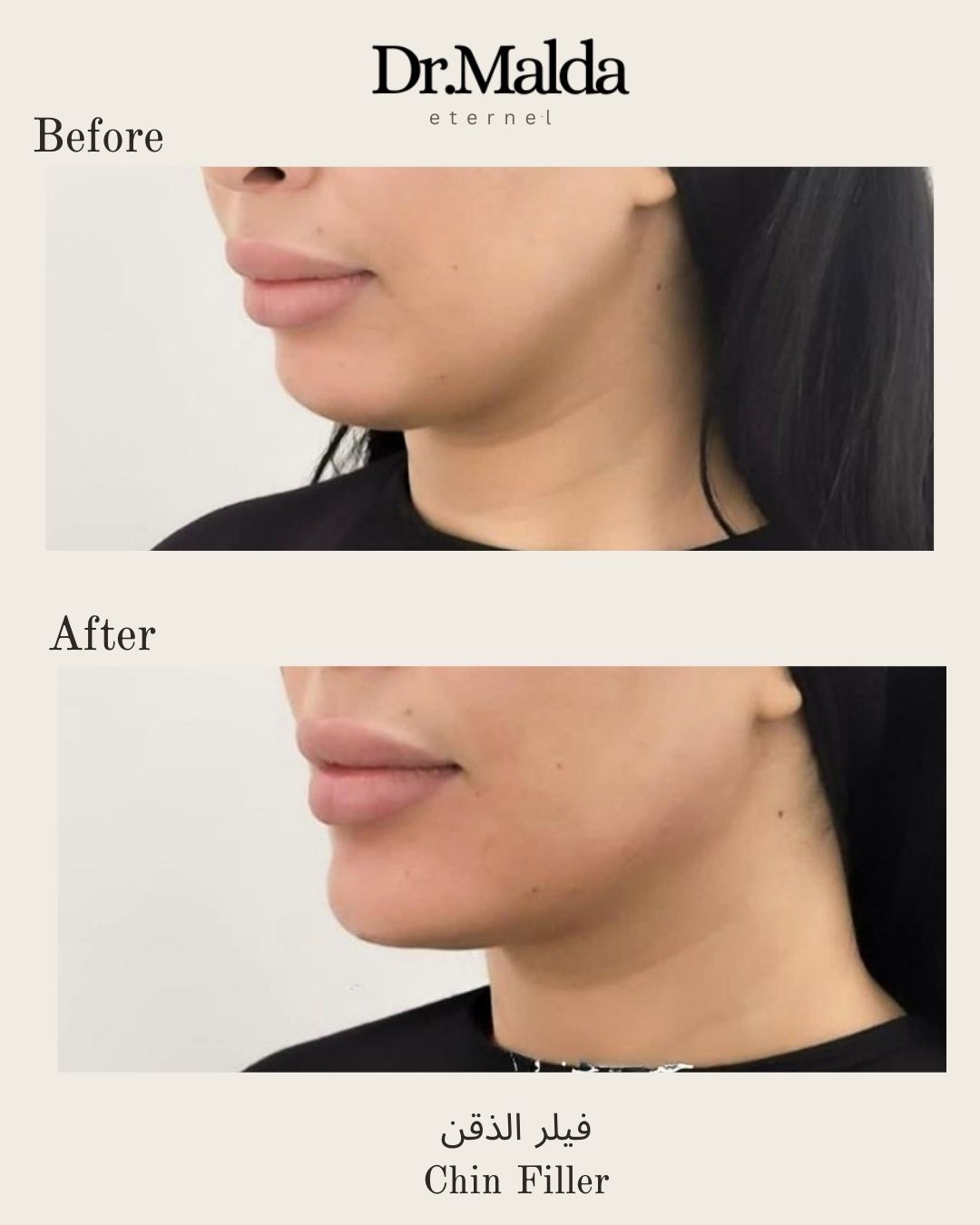 Chin filler