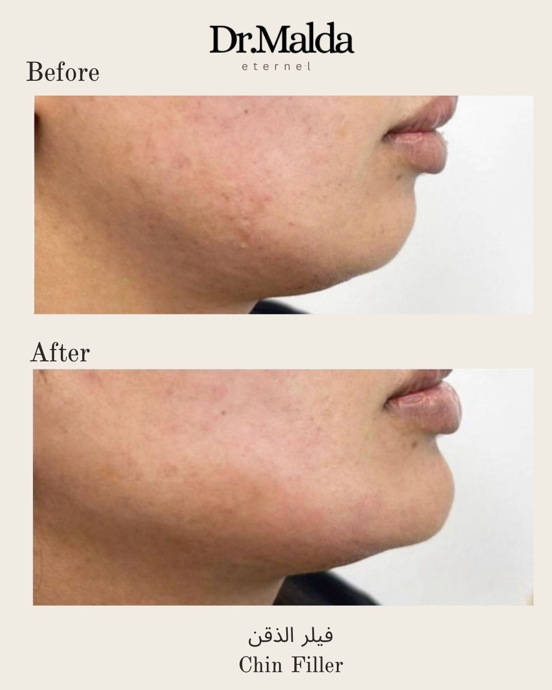 Chin filler(2)
