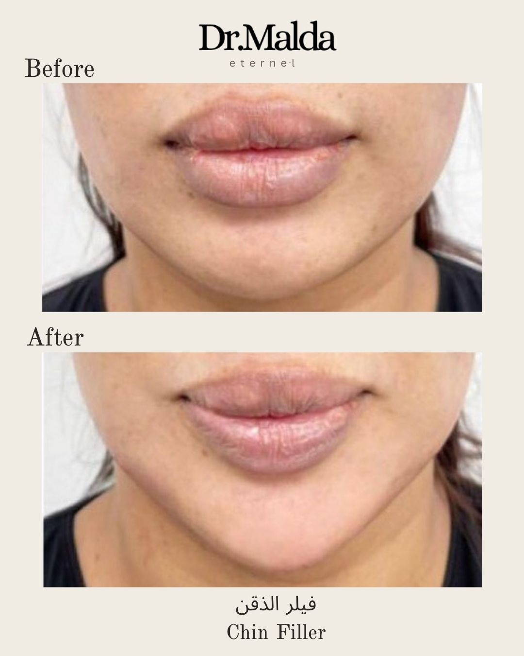 Chin filler(3)