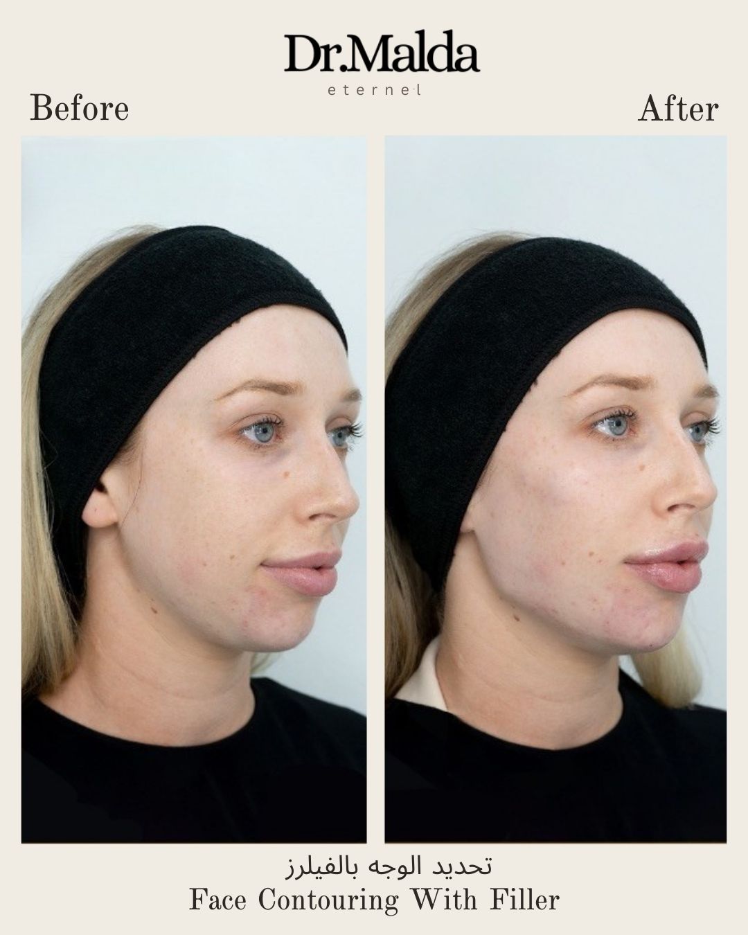 Full face contouring with fillers
