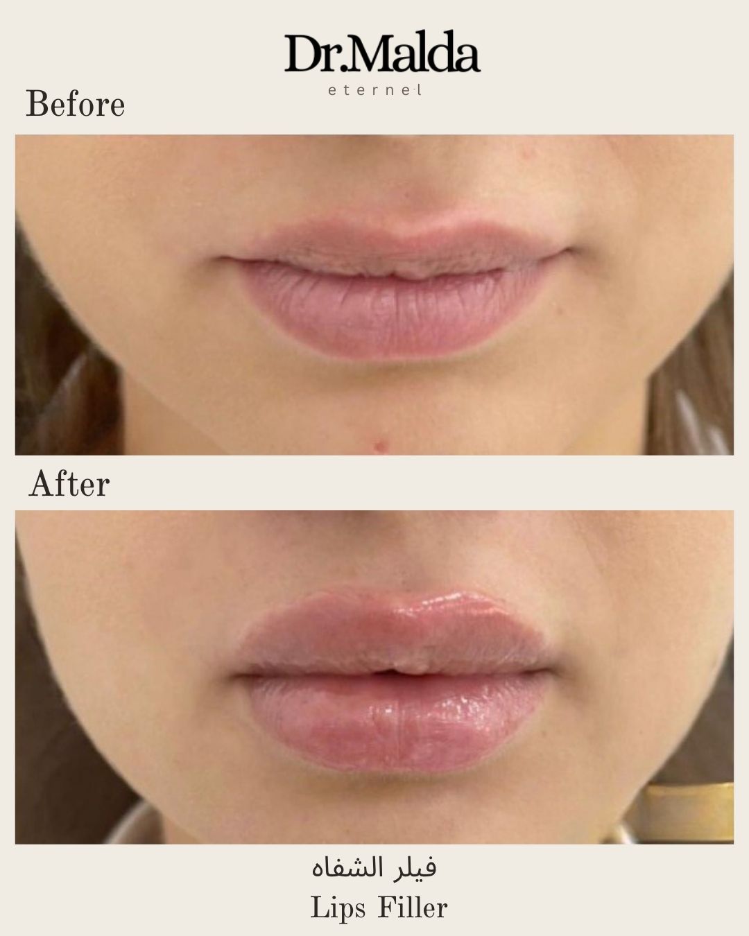 Lip fillers