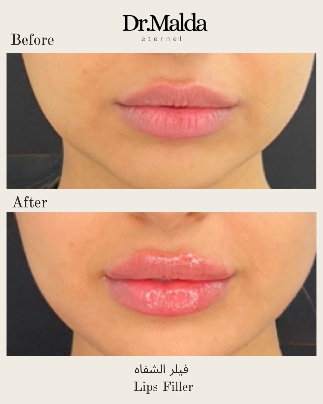 Lip fillers(1)