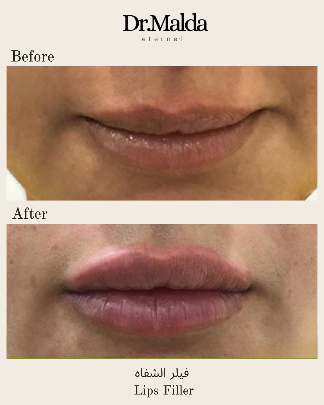 Lips fillers