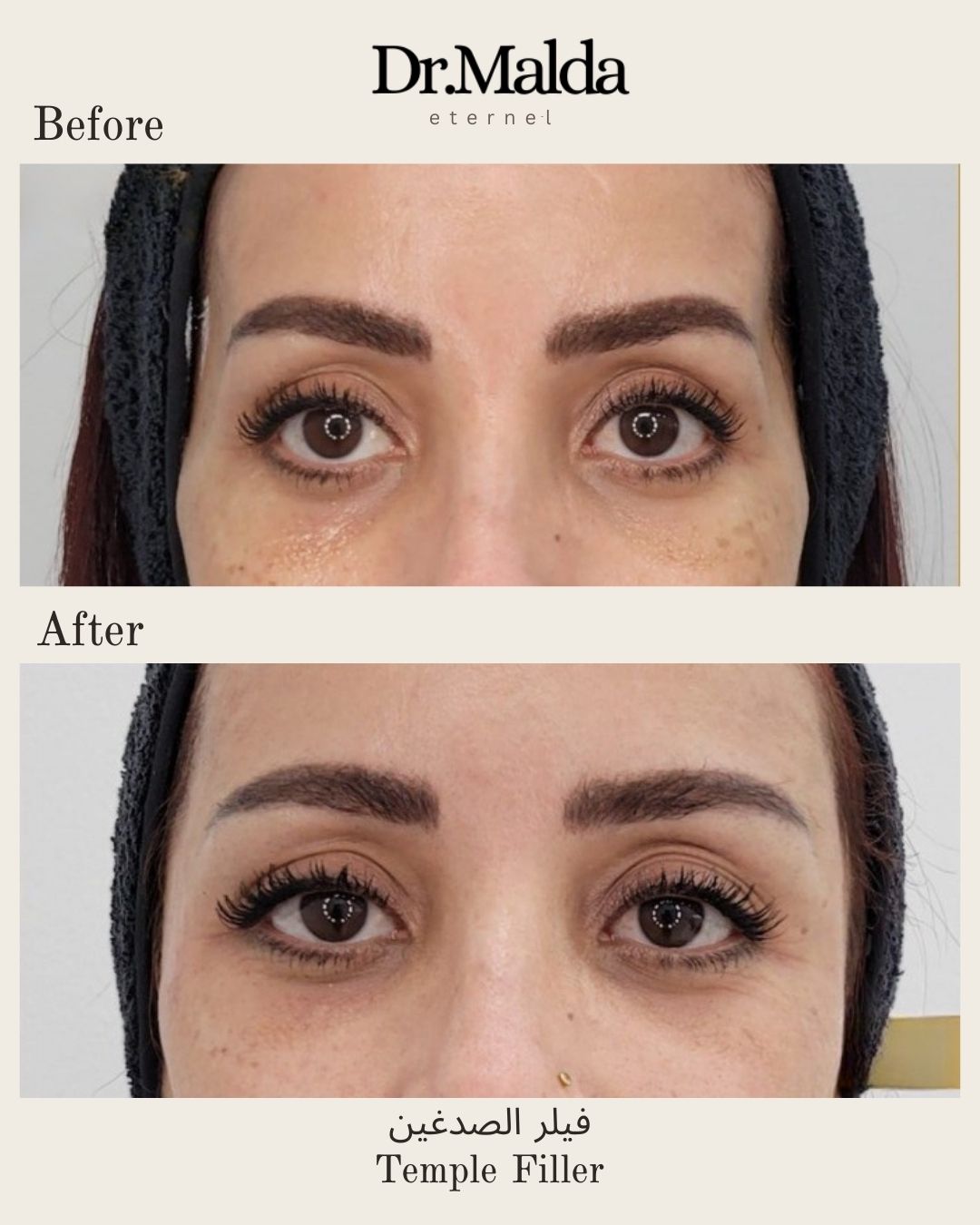 Temples fillers