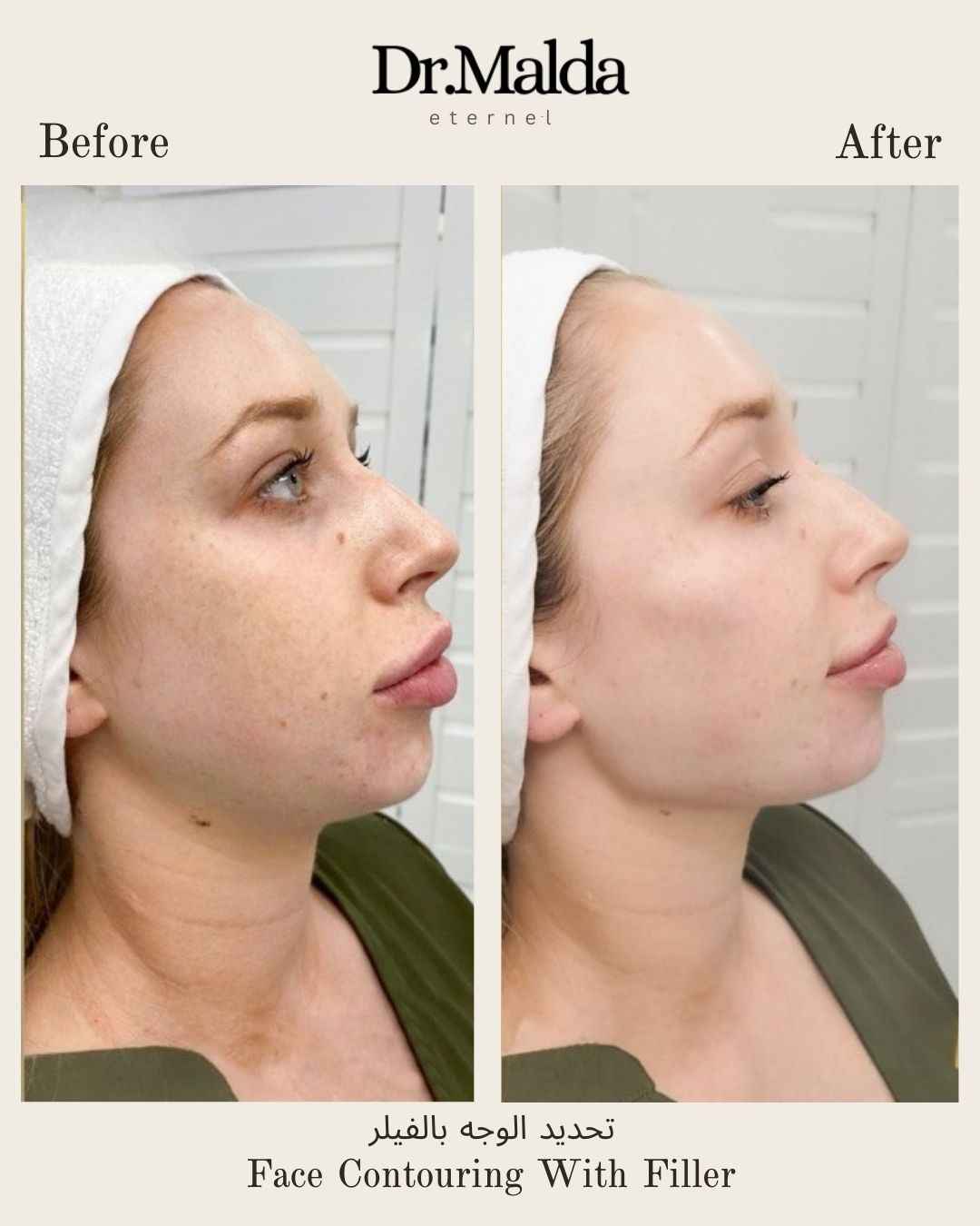 FAce-contouring.-with.-fillers_11zon
