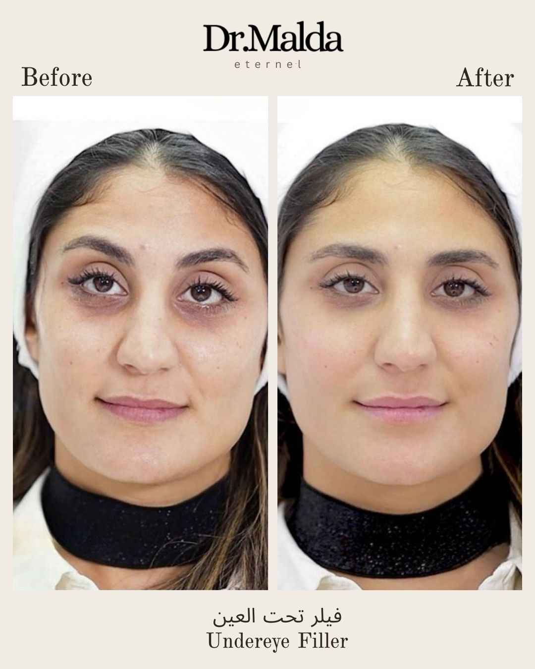 Undereyes-fillers_11zon