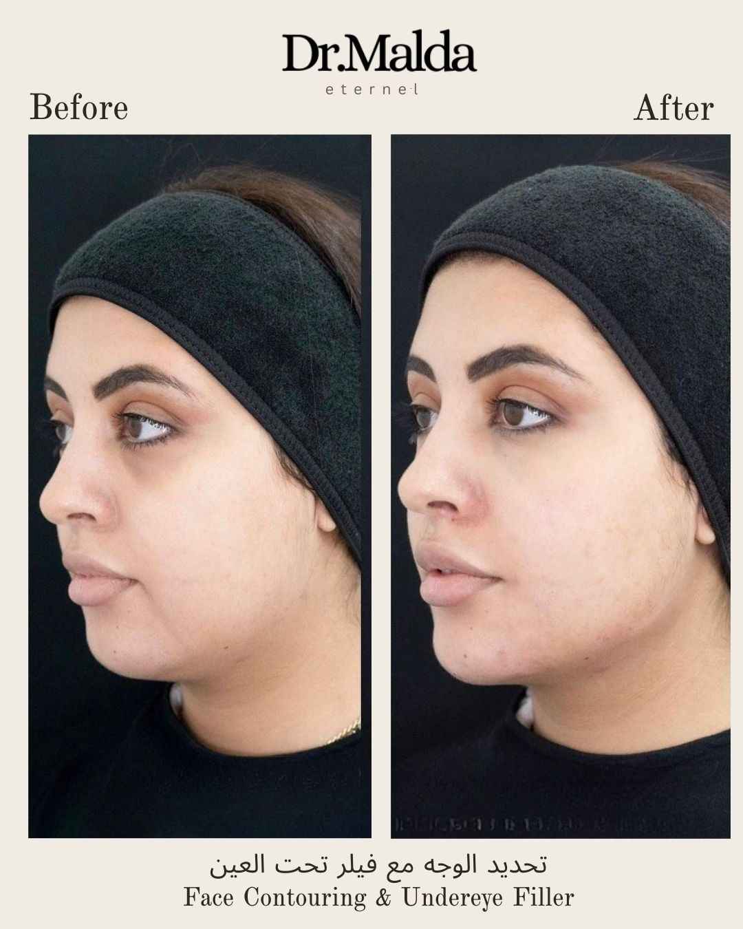 face-contouring.-with.-fillers1_11zon